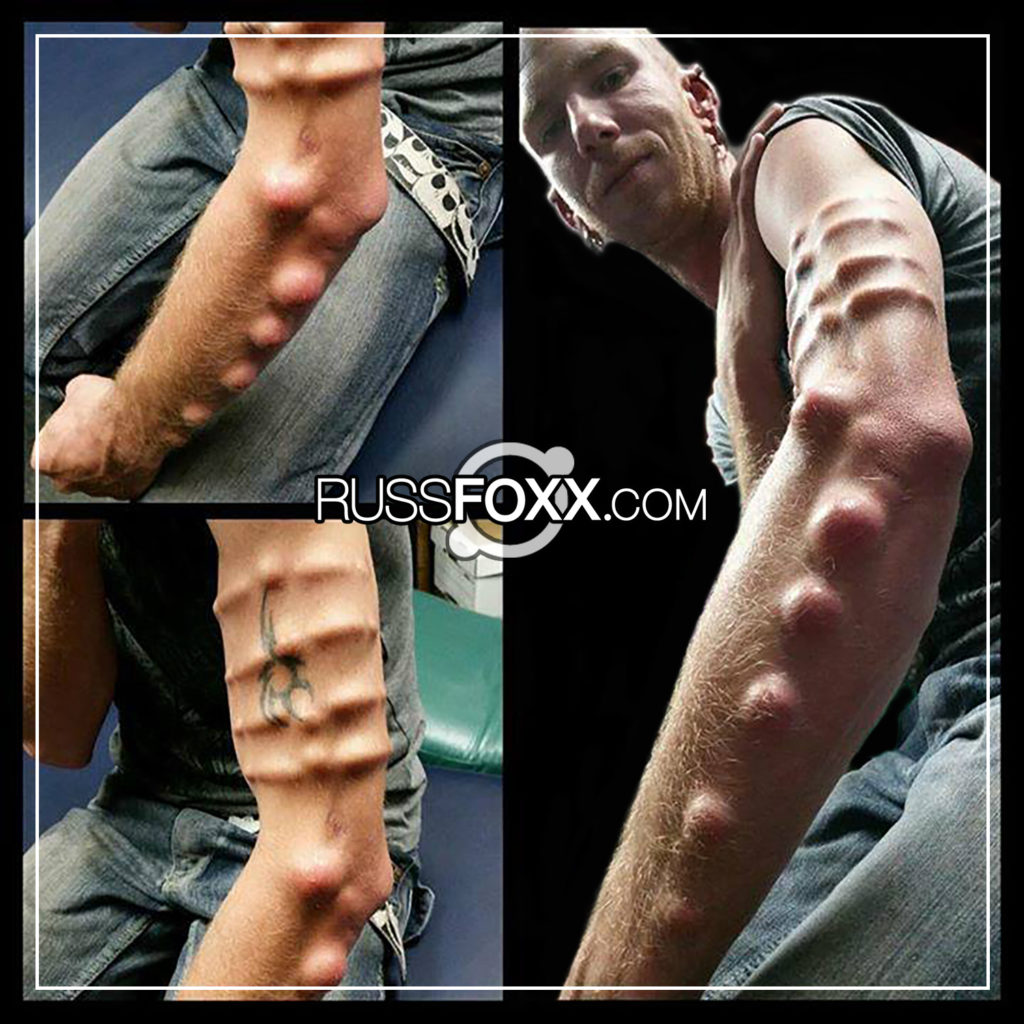 Subdermal Implants – Russ Foxx