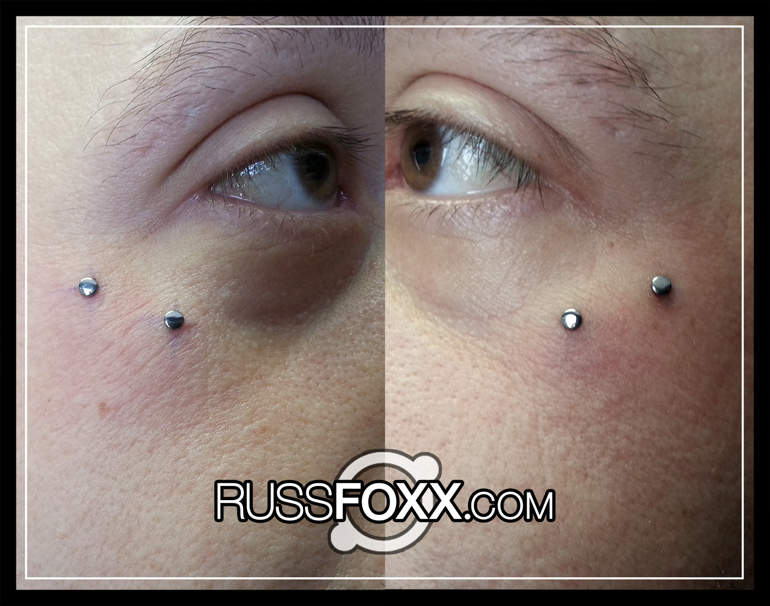 Microdermal Anchors Russ Foxx